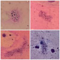 Pneumocystis 2