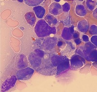 Disseminate Histoplasmosis