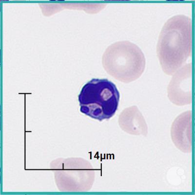 Apoptotic lymphocyte 1