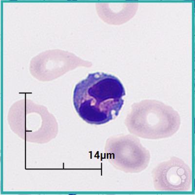 Apoptotic lymphocyte 2