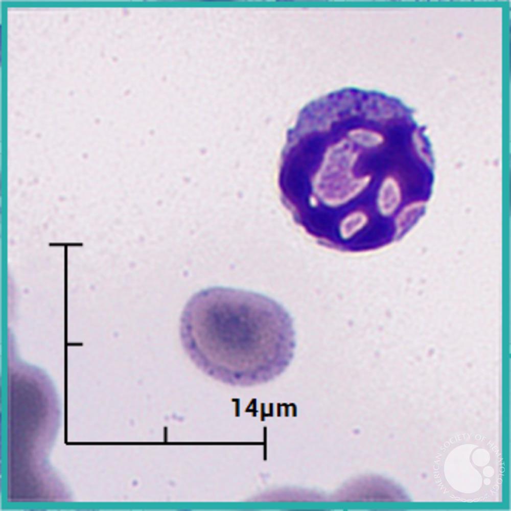 Apoptotic lymphocyte 3