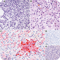 Multiple myeloma presenting with hepatic light chain deposition