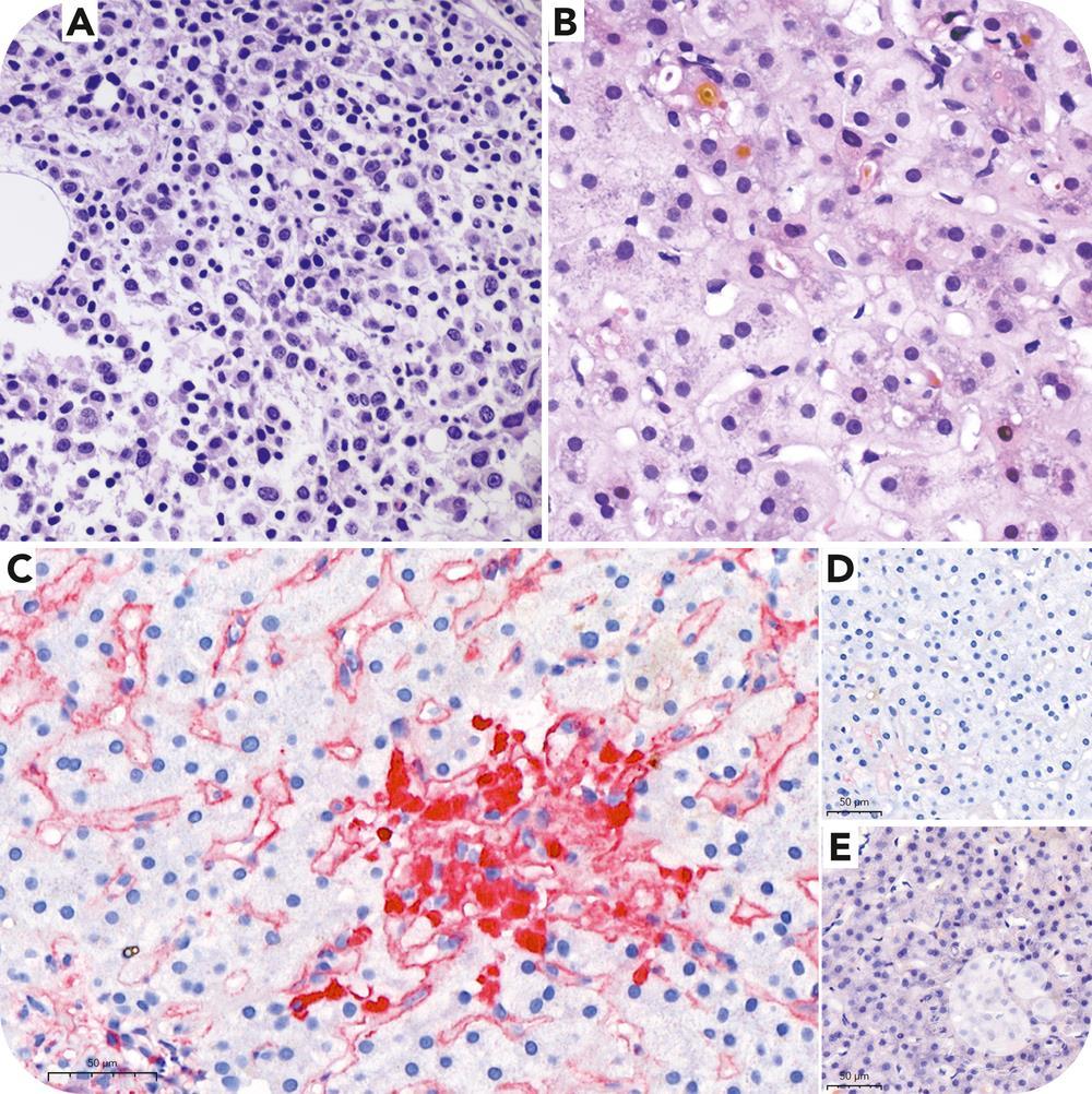 Multiple myeloma presenting with hepatic light chain deposition
