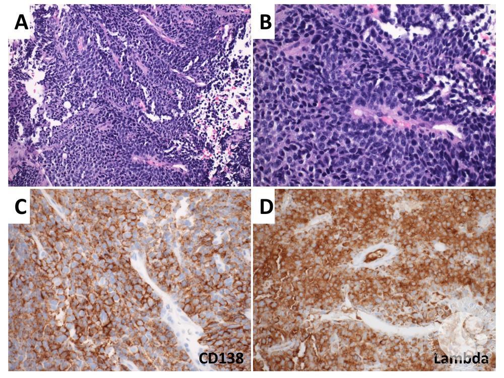 Plasma cell neoplasm with papillary architecture mimicking carcinoma