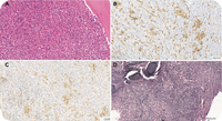 A Challenging Diagnosis Of Myeloidlymphoid Neoplasm With Eosinophilia And Fip1l1pdgfra 