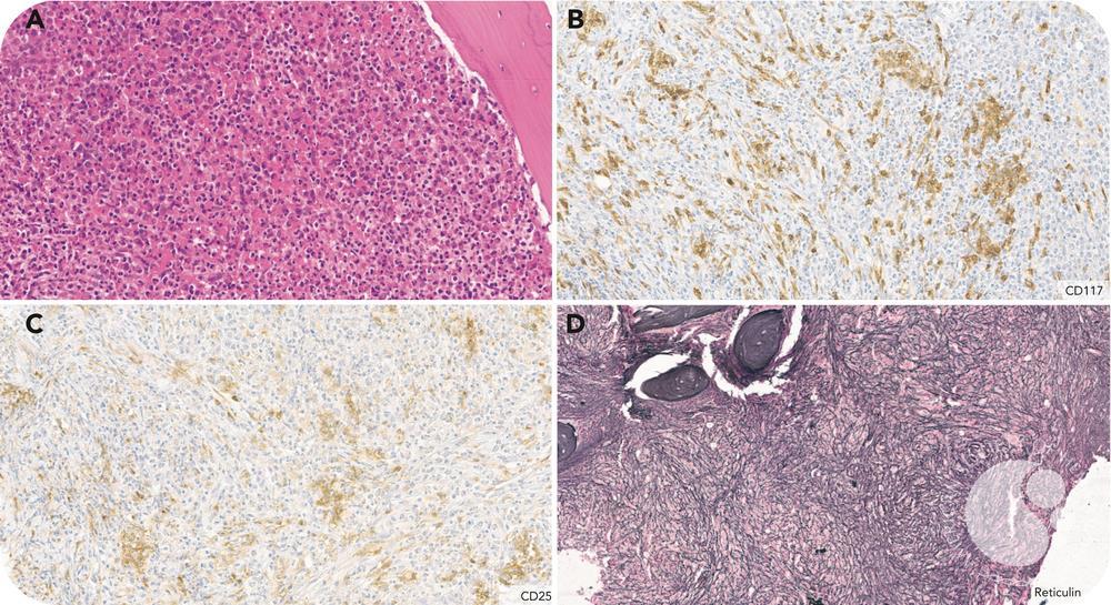 A challenging diagnosis of myeloid/lymphoid neoplasm with eosinophilia and FIP1L1::PDGFRA rearrangement