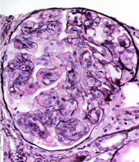 Membranoproliferative Glomerulonephritis