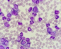 Chronic myeloid leukemia(CML) with BCR::ABL1 fusion, chronic phase.