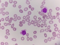 Hairy cell-manual peripheral smear-2