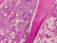 Bone marrow biopsy -fried egg appearance -hairy cell