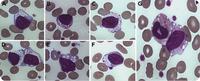 Vacuolated lymphocytes, a leading piece of diagnostic evidence for a rare storage disorder