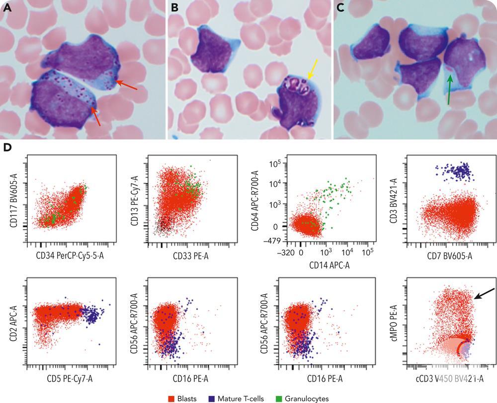 Pediatric mixed phenotype acute leukemia, T/myeloid, with isolated FLT3 mutation