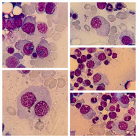 Multiple Myeloma