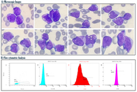 HLA-DR Negative AML