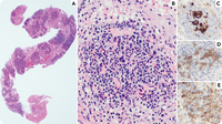 VEXAS’d by lymphadenopathy: an unusual case of extramedullary hematopoiesis