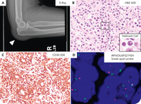 IRF4/DUSP22-positive anaplastic large cell lymphoma arising in the setting of chronic olecranon bursitis