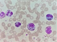 Peripheral smear Eosinophilia