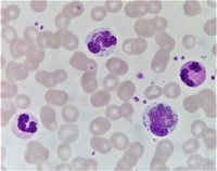 Peripheral blood Eosinophilia 1