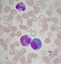 Peripheral blood Eosinophilia 2