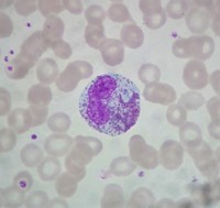 Peripheral blood Eosinophilia 3