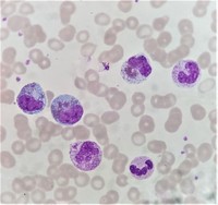 Peripheral blood Eosinophilia 4