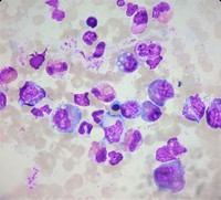 Bone marrow aspirate