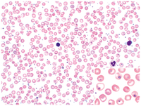 Hemoglobin Southampton (Casper) inclusions resembling intracellular parasites