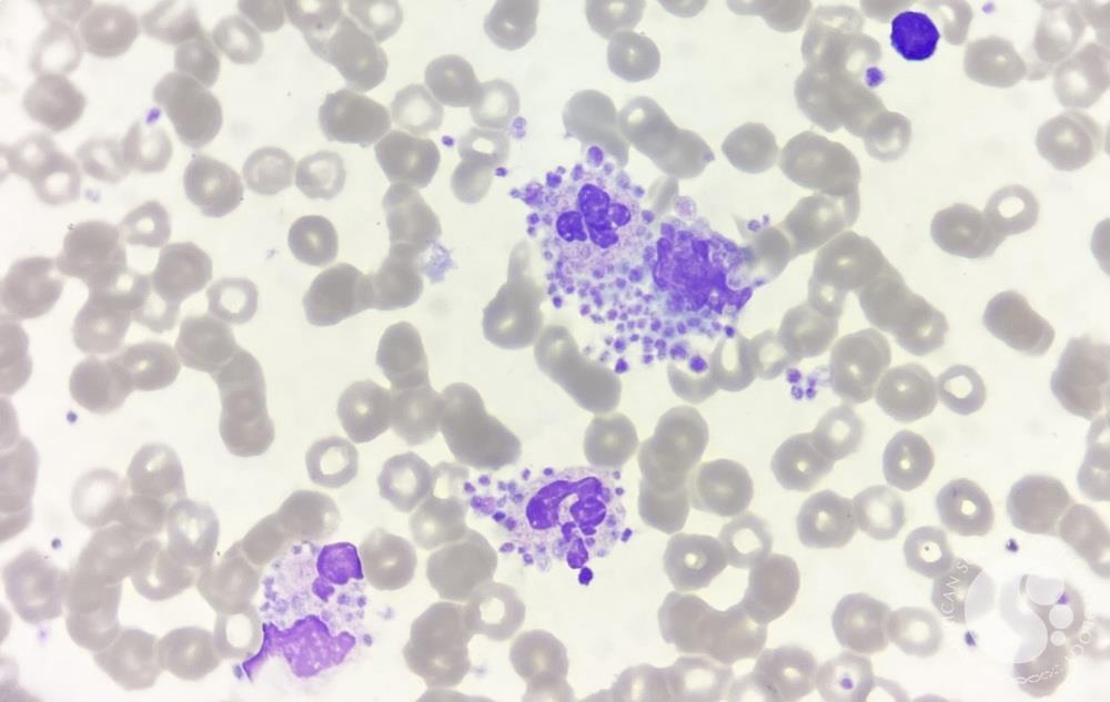 Platelet satellitism around leucocytes 1