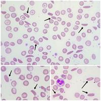 Hemoglobin C Crystals