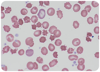 Acanthocytosis: a key feature for the diagnosis of abetalipoproteinemia