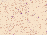 Delayed Haemolytic Transfusion Reaction