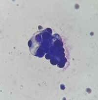 Malignant Pleural Effusion 2