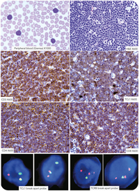 T-cell prolymphocytic leukemia/lymphoma with TCRB::TCL1 translocation