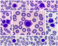 Hairy Cell Leukemia