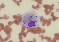 Macrophage with engulfed RBCs and cell debris