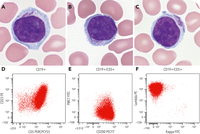 Auer rod–like inclusions in chronic lymphocytic leukemia