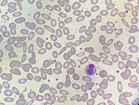 Hereditory Elliptocytosis- Peripheral smear image(100x)showing more than 30% of elliptical shaped RBCs.