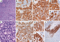 Peripheral T-cell lymphoma with TFH phenotype and associated indolent T-lymphoblastic proliferation