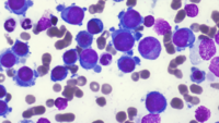 Acute erythroid leukemia