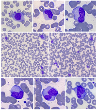 Atypical Lymphocytes in infectious mononucleosis