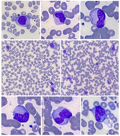 Atypical Lymphocytes in infectious mononucleosis