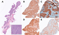 Follicular lymphoma involving the synovium in rheumatoid arthritis