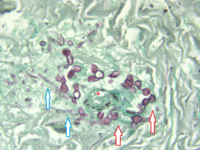 Skin Biopsy 1) Gomori’s methenamine silver; 400x