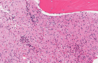 Bone marrow involvement by Gaucher's disease.