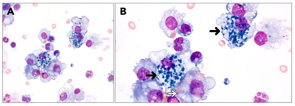 Pulmonary hemosiderin-laden macrophages