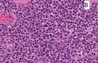 Monomorphic Epitheliotropic Intestinal T-cell Lymphoma 2