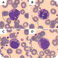 Diagnostic peripheral blood smear for Chédiak-Higashi syndrome in a 43 ...