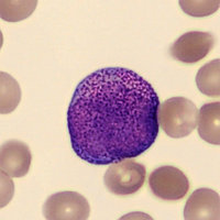 Hypergranular promyelocytes
