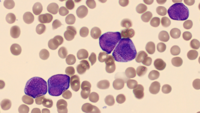 Blood smear with hypergranular blasts