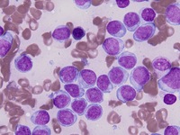 Blastic Plasmacytoid Dendritic Cell Neoplasm 6